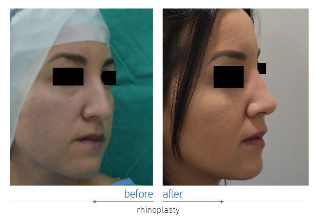 Rhinoplasty Before and After