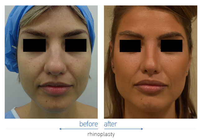 Rhinoplasty Before and After