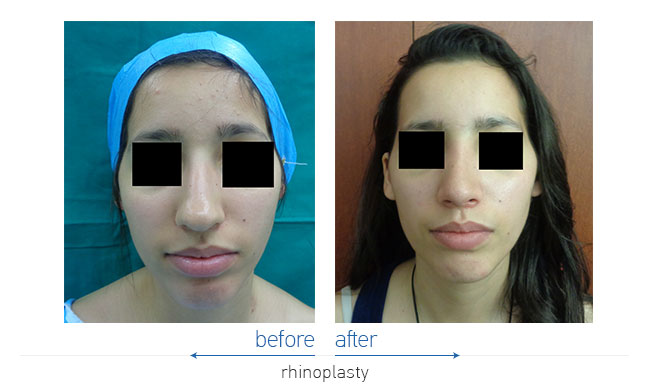 Rhinoplasty Before and After