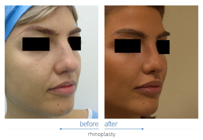 Rhinoplasty Before and After
