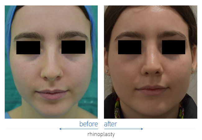 Rhinoplasty Before and After