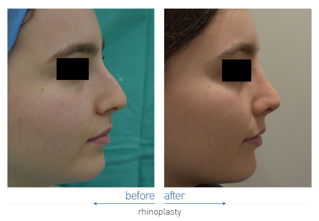 Rhinoplasty Before and After
