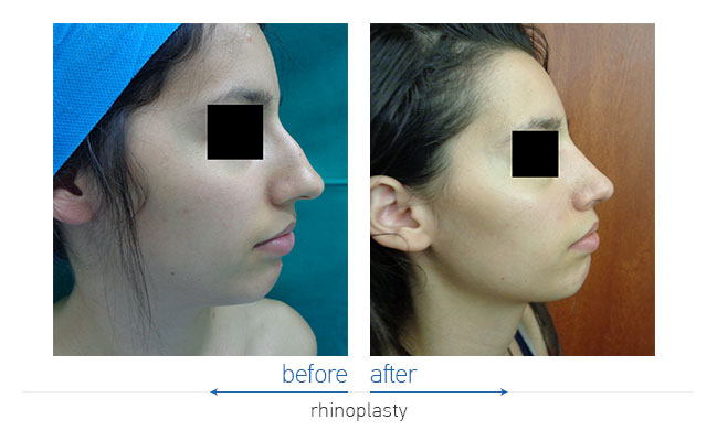 Rhinoplasty Before and After