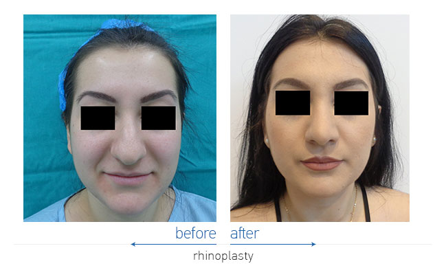 Rhinoplasty Before and After
