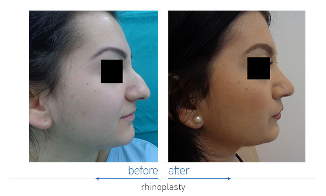 Rhinoplasty Before and After