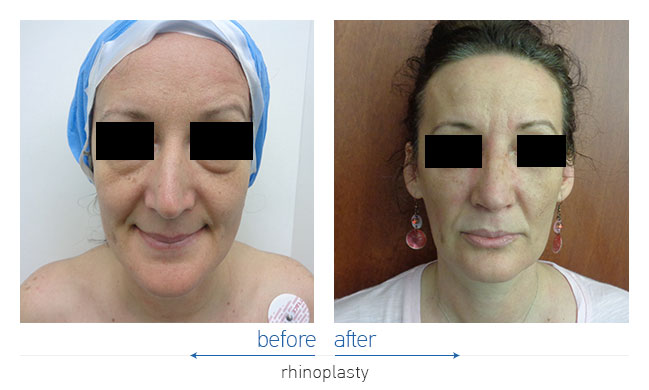 Rhinoplasty Before and After