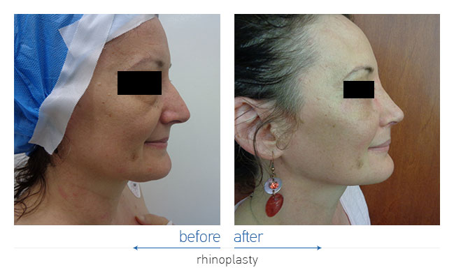 Rhinoplasty Before and After