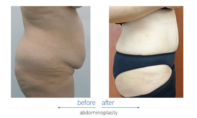 Tummy Tuck Before and After