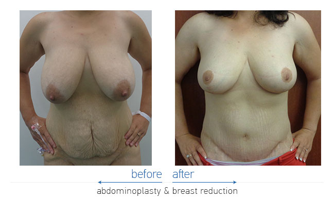 Tummy Tuck Before and After