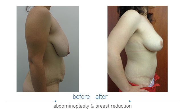 Tummy Tuck Before and After