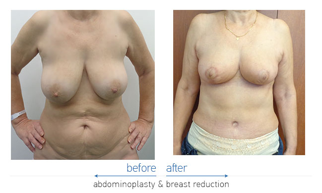 Tummy Tuck Before and After