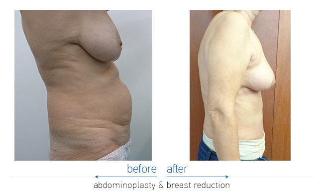 Tummy Tuck Before and After