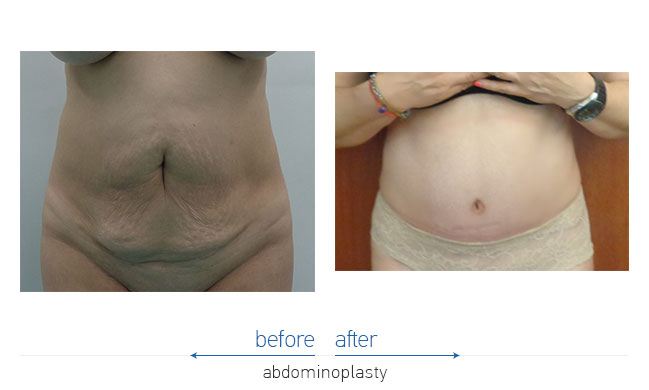 Tummy Tuck Before and After
