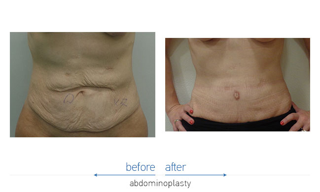 Tummy Tuck Before and After