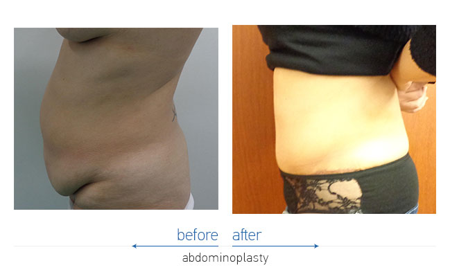 Tummy Tuck Before and After
