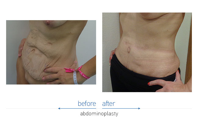 Tummy Tuck Before and After
