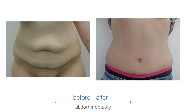 Tummy Tuck Before and After