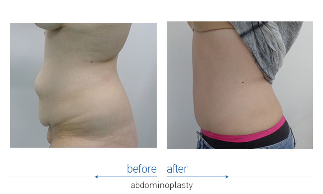 Tummy Tuck Before and After