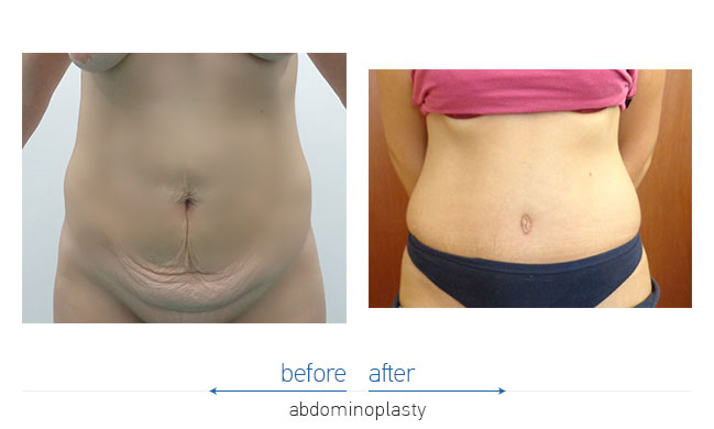 Tummy Tuck Before and After