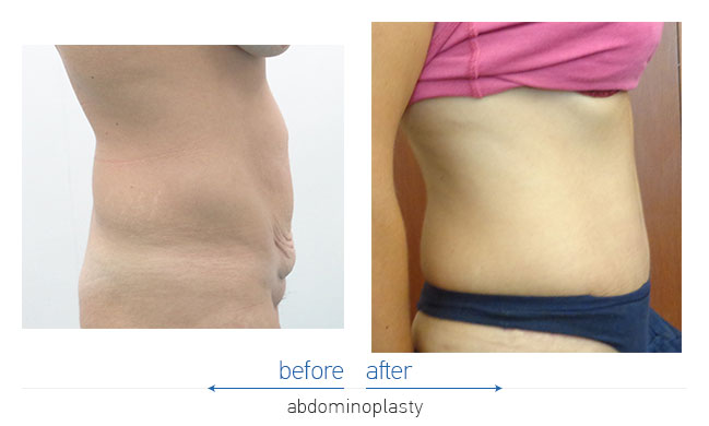 Tummy Tuck Before and After