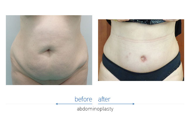 Tummy Tuck Before and After